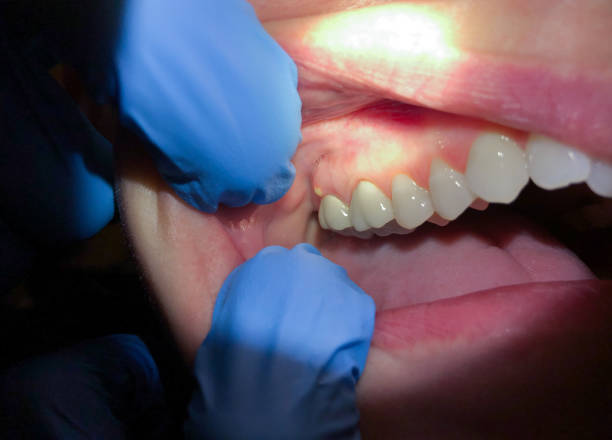 Best Emergency Root Canal Treatment in Giddings, TX